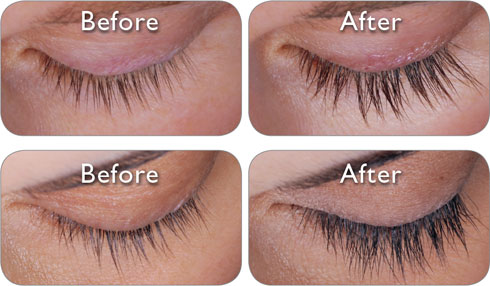 latisse eye discoloration